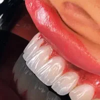 کامپوزیت در اقساط ویژه