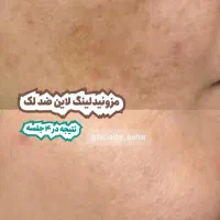 مزونیدلینگ حرفه‌ای در کلینیک زیبایی/هاشمیه|خدمات آرایشگری و زیبایی|مشهد, چهارچشمه|دیوار
