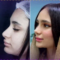 عمل زیبایی بینی با بهترین شرایط|خدمات آرایشگری و زیبایی|داراب, |دیوار