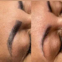 پاک کردن تتو صورت فقط با یک جلسه
