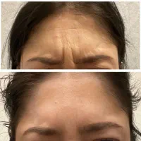 جشنواره زیبایی((مدل ژل وبوتاکس))|خدمات آرایشگری و زیبایی|سنندج, |دیوار