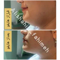 هایفوتراپی لیزر پاکسازی پلاژن روشن سازی فیشیال|خدمات آرایشگری و زیبایی|شیراز, ریاستی|دیوار