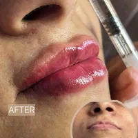 مدل فیلر و بوتاکس و پرسینگ