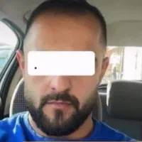 کاشت مو و ابرو بدون پیش پرداخت با چک و حتی سفته
