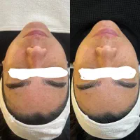 فیشال پوست+آموزش فیشال مدرس فنیوحرفهای|خدمات زیبایی و سلامت|رشت, بلوار گیلان|دیوار