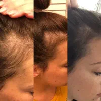 درمان ریزش مو ورشد مجدد مو|آرایشی، بهداشتی، درمانی|زنجان, |دیوار