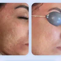 پکیج جوانسازی،هایفوصورت،واژینال،درمان تیرگی،بوتاکس|خدمات زیبایی و سلامت|تهران, هاشمی|دیوار