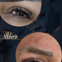 پاک کردن تتو صورت و بدن با دستگاه لیزر کیوسوییچ