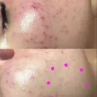 خال برداری،نیدل،اسید تراپی،کربکسی،رفع لک و جوش