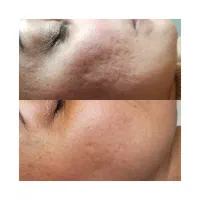 جوانسازی فوری/در یک جلسه/در یک ساعت|خدمات آرایشگری و زیبایی|رشت, کوی حسینی|دیوار