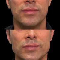 تزریق ژل و بوتاکس