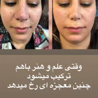 کوچک شدن بینی تضمینی فقط با ۵ میلیون|خدمات آرایشگری و زیبایی|تهران, هاشمی|دیوار