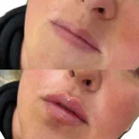 خدمات زیبایی فیلر و بوتاکس تضمینی