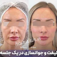 جشنواره50%تزریق ژل لب لیفت آنزیم 390بوتاکس لیزر