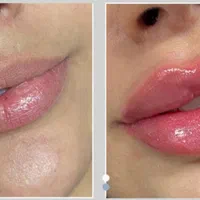 آف چربی بوتاکس ساکشن غبغب ژل مزو PRP، پزشک مجرب|خدمات آرایشگری و زیبایی|زاهدان, |دیوار