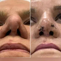 عمل بینی ترمیمی/گوشتی/استخونی/لیپوساکشن/آفر پلک