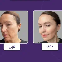 پکیج جوانسازی،هایفوصورت،واژینال،درمان تیرگی،بوتاکس|خدمات زیبایی و سلامت|تهران, هاشمی|دیوار
