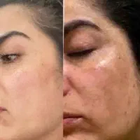 کرم ضدلک فرانسوی