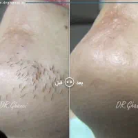 لیزررایگان