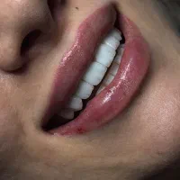 کامپوزیت و لمینتVIP / لبخند جذاب هالیوودی
