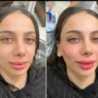 تزریق ژل و بوتاکس