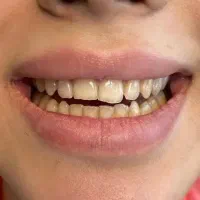 جشنواره کامپوزیت دندان از واحدی 800تومن شروع قیمت|خدمات آرایشگری و زیبایی|صفادشت, |دیوار