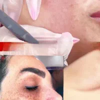 درمان تخصصی لک و کک و مک|خدمات آرایشگری و زیبایی|ساری, |دیوار