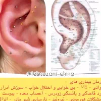 درمان تضمینی بیماری ها با طب سوزنی گوش ای اس پی