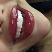 دندانپزشکی/لمینیت /کامپوزیت/روکش/اقساطی