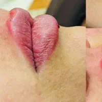 ژل و بوتاکس