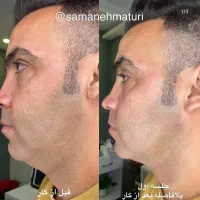 هایفو ریمووتتو پاکسازی فرکشنال جوانسازی پلاسما