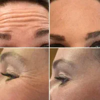 اف ویژه ژل بوتاکس پرسینگ
