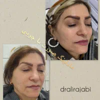 بوتاکس ژل فیلر چربی بلفاروپلاستی مزو PRP نخ لیزر|خدمات آرایشگری و زیبایی|شاهین‌شهر, فردوسی|دیوار