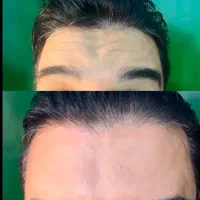 تخفیف بوتاکس