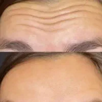 بوتاکس پیشانی ، صورت و بدن