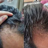 .پک گیاهی تقویتی و ضد ریزش و رویش مجدد مو|آرایشی، بهداشتی، درمانی|چالدران, |دیوار