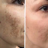 تزریق ژل فیلر بوتاکس تخفیف پاییزی|خدمات آرایشگری و زیبایی|اصفهان, مرداویج|دیوار