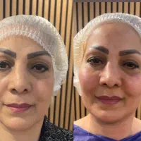 بهترین دکتر تزریق چربی تهران|خدمات زیبایی و سلامت|تهران, سعادتآباد|دیوار