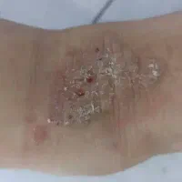 در مان اگزما قطعی