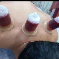 حجامت و بادکش گرم درمانی|خدمات آرایشگری و زیبایی|اصفهان, باغ فدک|دیوار