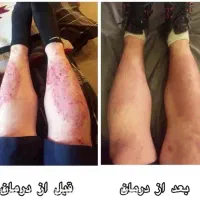 درمان پسوریازیس یا صدفک با گیاهان درمانی|آرایشی، بهداشتی، درمانی|اهواز, دانشگاه چمران|دیوار