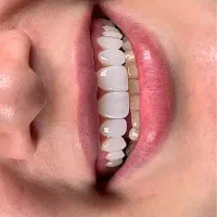 کامپوزیت دندان با گارانتی و ضمانت تا ۵سال