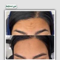 اف ویژه بوتاکس تعداد محدود|خدمات آرایشگری و زیبایی|یاسوج, |دیوار