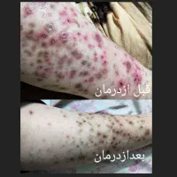 آب درمانی توسط خودتان در منزل