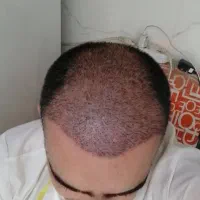 جشنواره کاشت مو وابرو