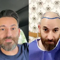 کاشت مو،کاشت ابرو، کاشت ریش، بلفاروپلاستی|خدمات آرایشگری و زیبایی|مشهد, کلاهدوز|دیوار