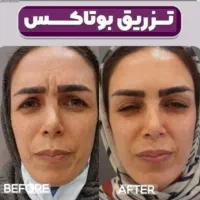 بوتاکس ژل صورت و بدن|خدمات آرایشگری و زیبایی|بیرجند, |دیوار