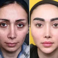 مدل برای جوانسازی و زیباسازی صورت لیفت و رفع لک