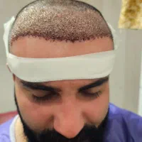 لیدر کاشت مو