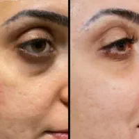 فیلرزیر چشم، زاویهفک، لیفت شقیقه، بوتاکس، لب نچرال|خدمات آرایشگری و زیبایی|مشهد, سرافرازان|دیوار